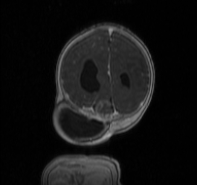 Chiari III malformation with occipital encephalocele (Radiopaedia 79446-92559 Coronal T1 C+ mpr 40).jpg
