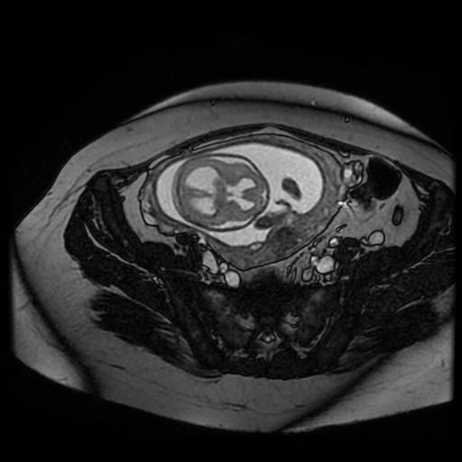 Chiari II malformation - fetal MRI (Radiopaedia 68099-77581 Axial Fiesta 39).jpg