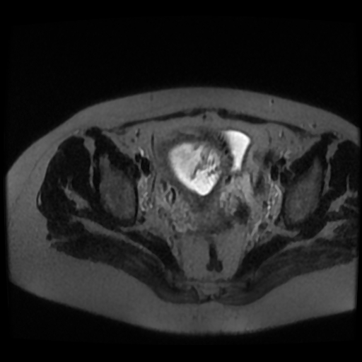 Chiari II malformation - fetal MRI (Radiopaedia 68099-77581 Axial T2-SSFSE 54).jpg