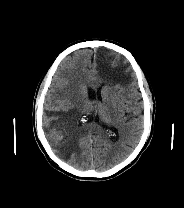 Cholangiocarcinoma with cerebral metastases (Radiopaedia 83519-98628 Axial non-contrast 39).jpg