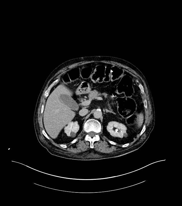 Cholangiocarcinoma with cerebral metastases (Radiopaedia 83519-98629 Axial C+ delayed 34).jpg