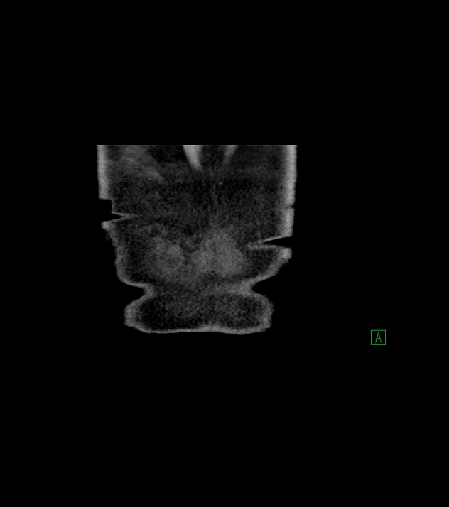 Cholangiocarcinoma with cerebral metastases (Radiopaedia 83519-98629 Coronal C+ delayed 84).jpg