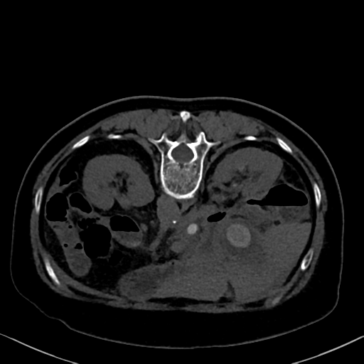 File:Cholecystitis - obstructive choledocholitiasis (CT intravenous cholangiography) (Radiopaedia 43966-47479 Axial 14).png