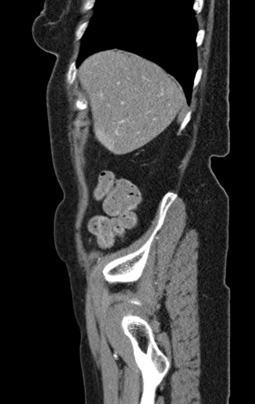 Cholecystoduodenal fistula due to calculous cholecystitis with gallstone migration (Radiopaedia 86875-103077 C 53).jpg