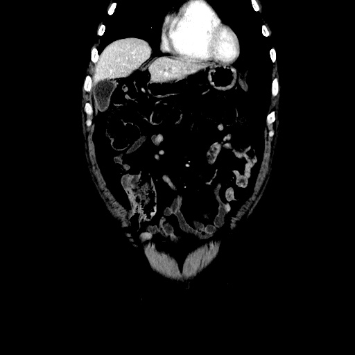 Choledocholiathiasis with normal caliber common bile duct (Radiopaedia 75368-86632 Coronal liver window 36).jpg