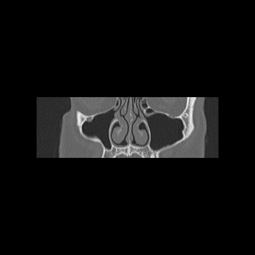 File:Cholesteatoma (Radiopaedia 84946-100455 Coronal bone window 34).jpg