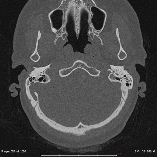 Cholesteatoma - external auditory canal (Radiopaedia 88452-105096 Axial bone window 21).jpg