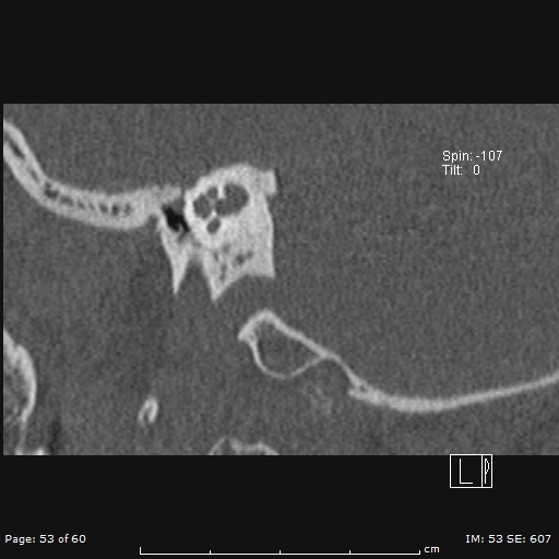 Cholesteatoma - external auditory canal (Radiopaedia 88452-105096 Sagittal bone window 53).jpg