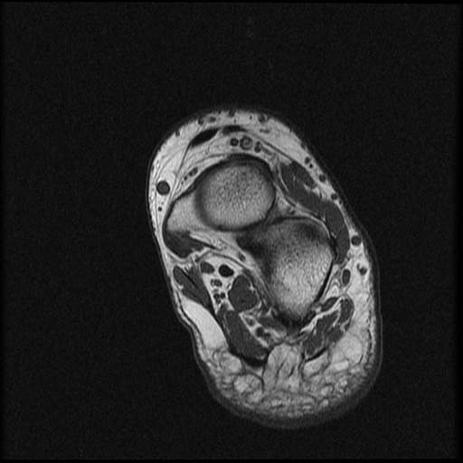File:Chondroblastoma - midfoot (Radiopaedia 64831-73765 Short axis T1 7).jpg