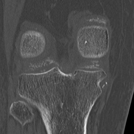 Chondrocalcinosis (Radiopaedia 16275-15955 Coronal bone window 41).jpg