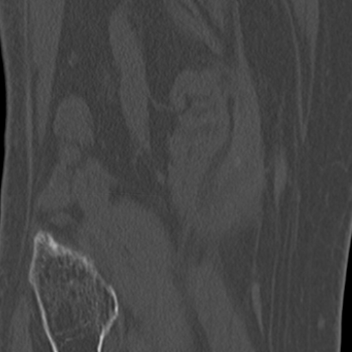 Chondrocalcinosis (Radiopaedia 16275-15955 Coronal bone window 49).jpg