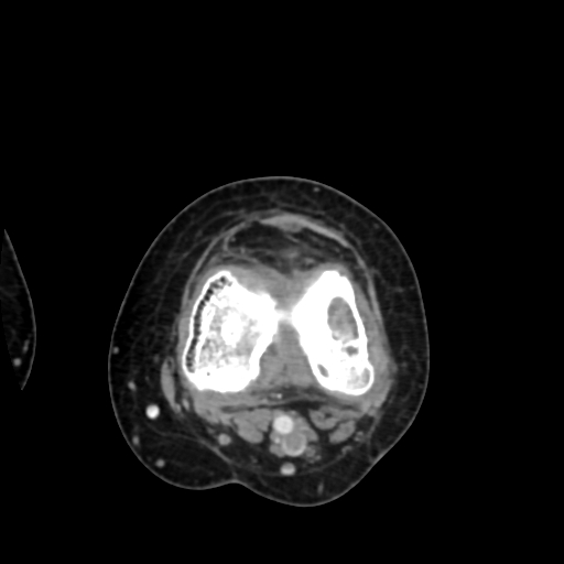 Chondrosarcoma - femur (Radiopaedia 64187-72954 Axial with contrast 53).jpg