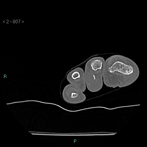 File:Chondrosarcoma - phalanx (Radiopaedia 69047-78812 Axial bone window 61).jpg
