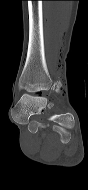 Chopart fracture (Radiopaedia 35347-36851 Coronal bone window 37).jpg