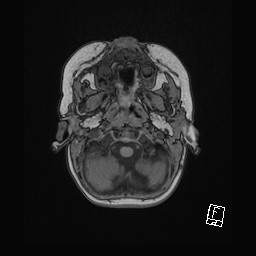Choroid plexus papilloma (Radiopaedia 92022-109829 Axial T1 4).jpg