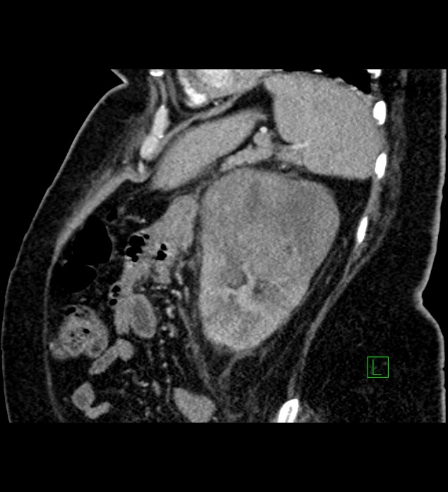 Chromophobe renal cell carcinoma (Radiopaedia 84239-99519 D 32).jpg