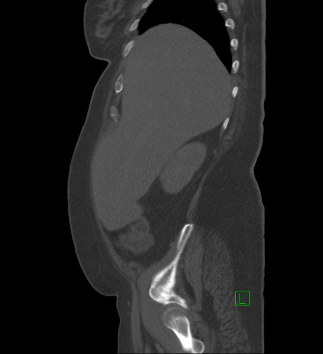 Chromophobe renal cell carcinoma (Radiopaedia 84239-99519 Sagittal bone window 87).jpg