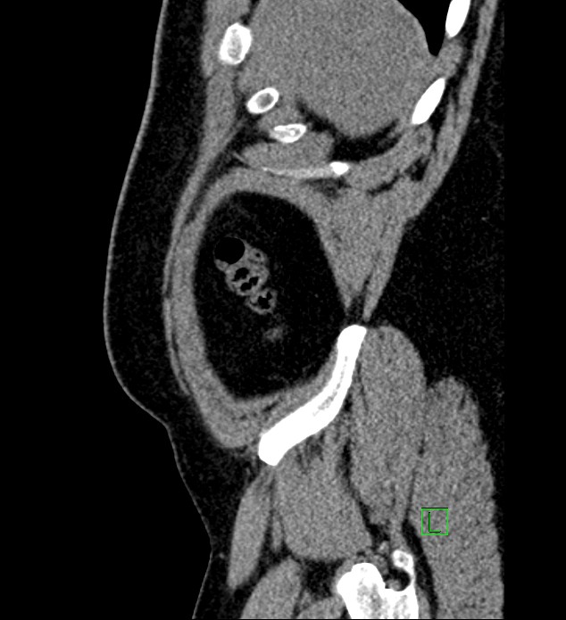 Chromophobe renal cell carcinoma (Radiopaedia 84286-99573 C 173).jpg