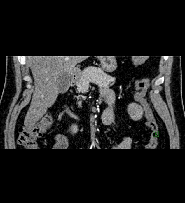 Chromophobe renal cell carcinoma (Radiopaedia 84286-99573 E 10).jpg
