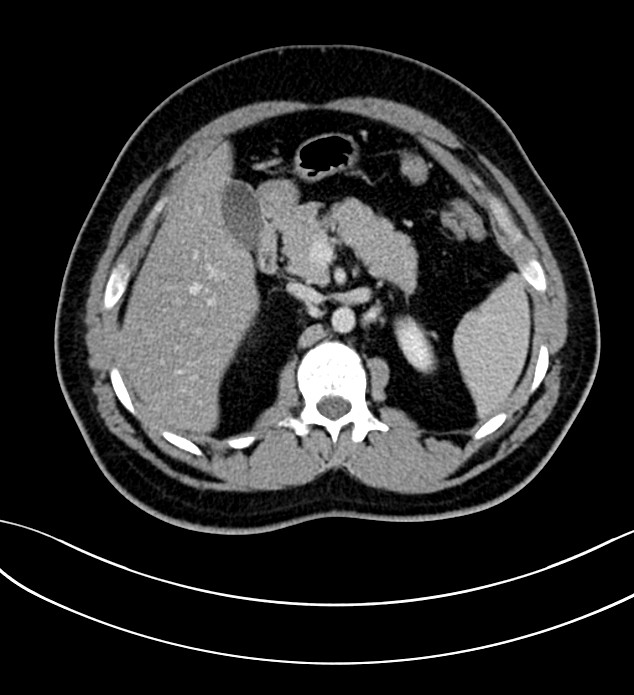 Chromophobe renal cell carcinoma (Radiopaedia 84286-99573 G 22).jpg