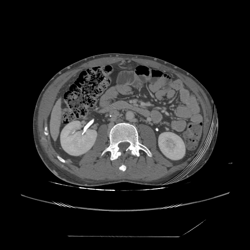File:Chronic IVC thrombosis and resultant IVC filter malposition (Radiopaedia 81158-94800 A 98).jpg