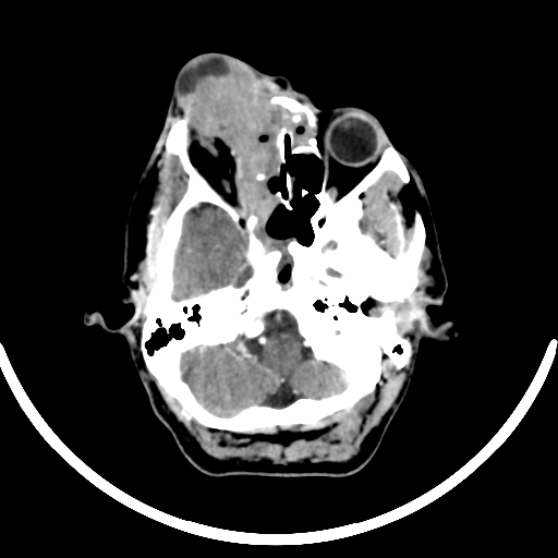 Chronic invasive fungal sinusitis with intraorbital and intracranial extension (Radiopaedia 56387-63046 B 92).jpg