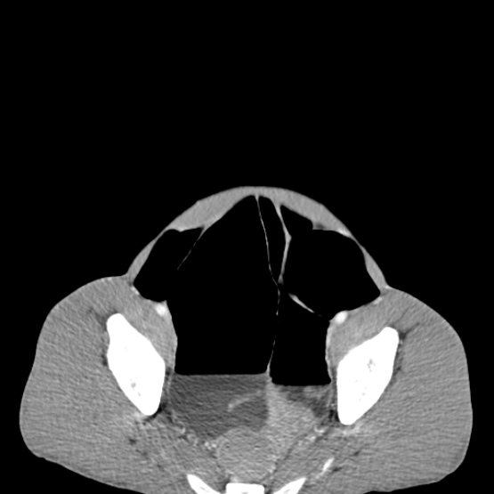 Chronic large bowel pseudo-obstruction (Radiopaedia 43181-46492 A 145).jpg