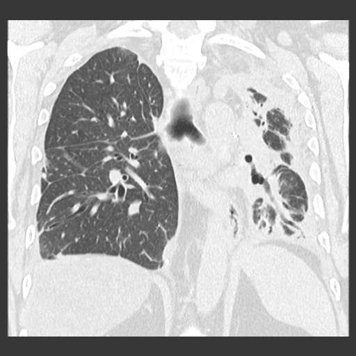 Chronic lung allograft dysfunction - restrictive form (Radiopaedia 60595-68316 Coronal lung window 66).jpg