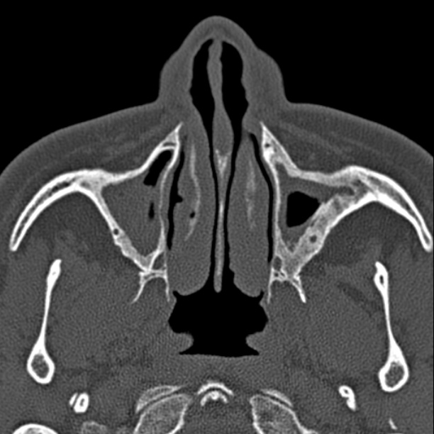Chronic maxillary sinusitis (Radiopaedia 27879-28116 Axial bone window 13).jpg
