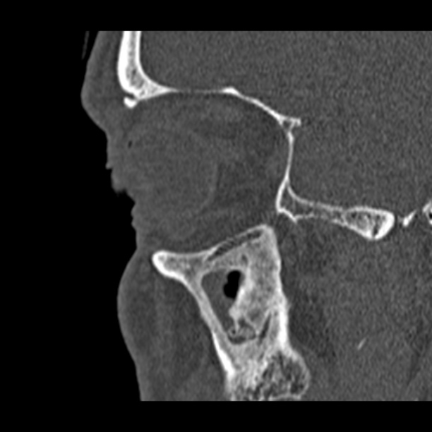 Chronic maxillary sinusitis (Radiopaedia 27879-28116 Sagittal bone window 47).jpg