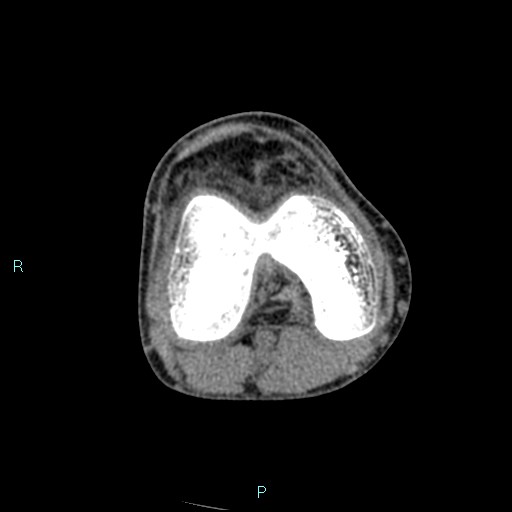 Chronic osteomyelitis (with Brodie abscess) (Radiopaedia 76405-88111 A 120).jpg
