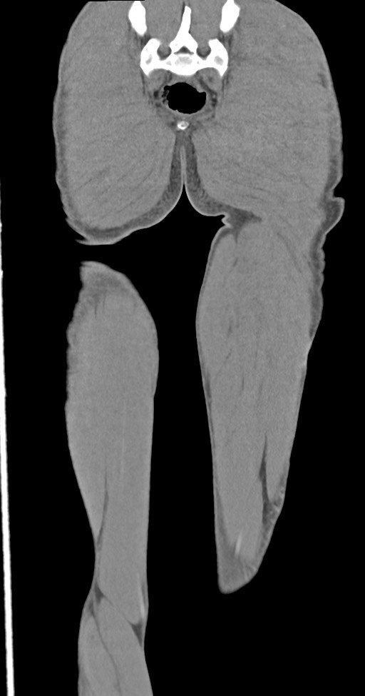 Chronic osteomyelitis (with sequestrum) (Radiopaedia 74813-85822 E 50).jpg