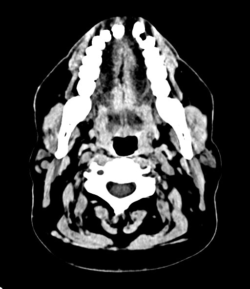 File:Chronic osteomyelitis - calvarial (severe) (Radiopaedia 69668-79616 Axial non-contrast 11).jpg