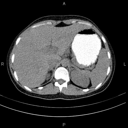 Chronic pancreatitis (Radiopaedia 64576-73450 Axial non-contrast 28).jpg