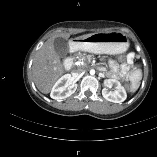 Chronic pancreatitis (Radiopaedia 64576-73450 B 52).jpg