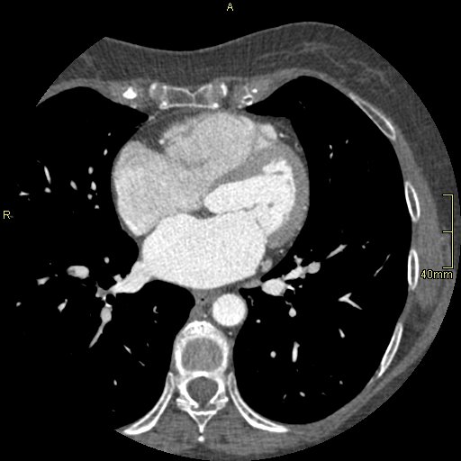 Chronic pulmonary embolism (Radiopaedia 73073-85094 Axial C+ CTPA 92).jpg