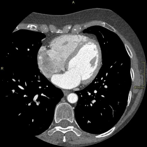 Chronic pulmonary embolism (Radiopaedia 73073-85094 Axial C+ CTPA 97).jpg