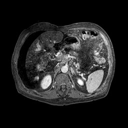 File:Cirrhosis and hepatocellular carcinoma in the setting of hemochromatosis (Radiopaedia 75394-86594 Axial T1 C+ fat sat 299).jpg