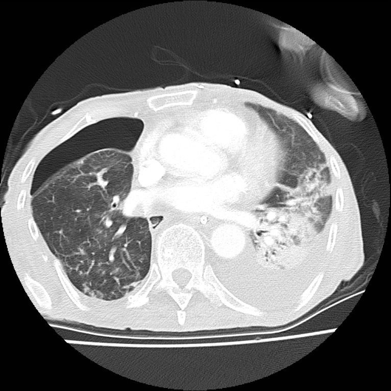 Clagett thoracotomy with bronchopleural fistula (Radiopaedia 29192-29587 Axial lung window 29).jpg