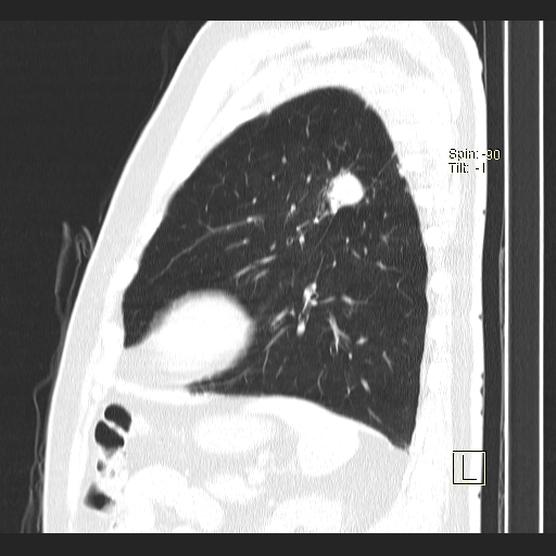 Classic complicated silicosis (Radiopaedia 49720-54961 Sagittal lung window 16).jpg
