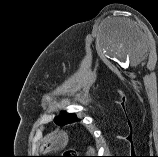 Clear cell chondrosarcoma - humerus (Radiopaedia 63104-71612 D 26).jpg