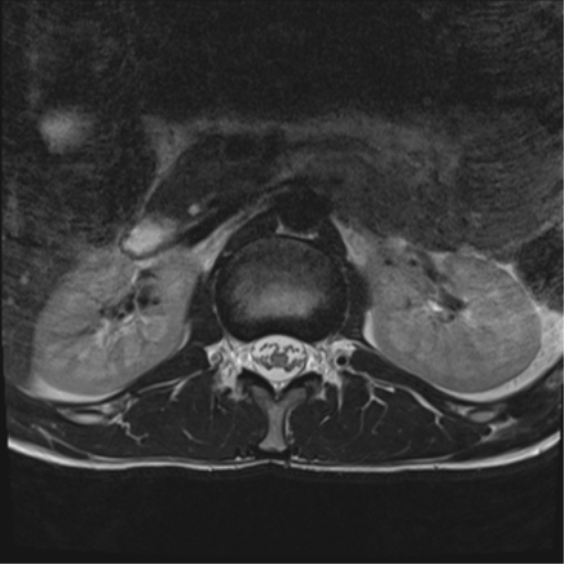 File:Clear cell meningoma - lumbar spine (Radiopaedia 60116-67690 Axial T2 40).png