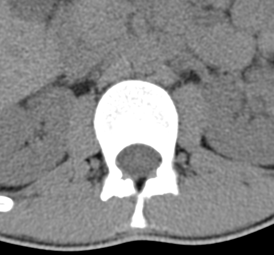 File:Clear cell meningoma - lumbar spine (Radiopaedia 60116-67691 Axial non-contrast 12).png