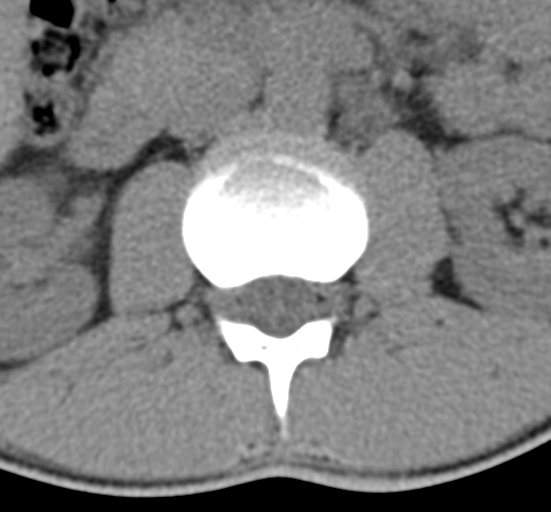 Clear cell meningoma - lumbar spine (Radiopaedia 60116-67691 Axial non-contrast 18).png