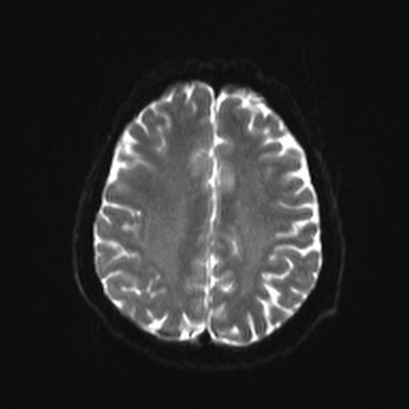 File:Clival meningioma (Radiopaedia 53278-59248 Axial DWI 18).jpg