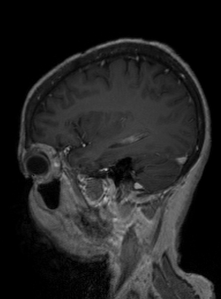 Clival meningioma (Radiopaedia 53278-59248 Sagittal T1 C+ 324).jpg