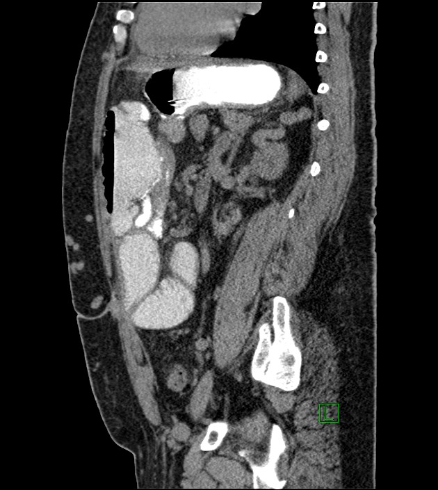 Closed-loop small bowel obstruction-internal hernia (Radiopaedia 78439-91096 C 60).jpg
