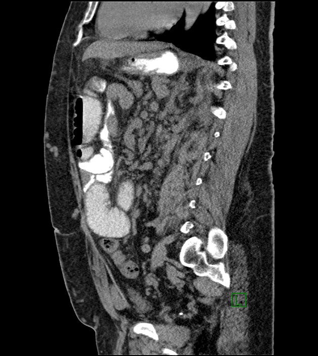 Closed-loop small bowel obstruction-internal hernia (Radiopaedia 78439-91096 C 66).jpg