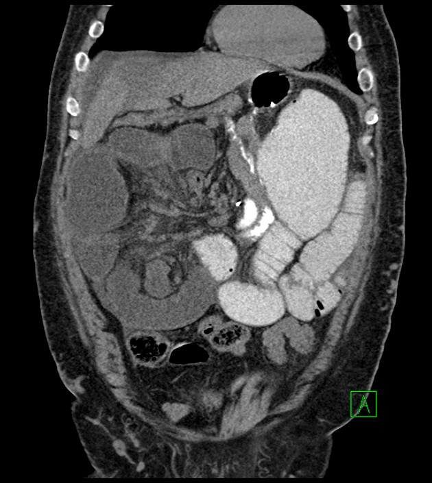 Closed-loop small bowel obstruction-internal hernia (Radiopaedia 78439-91096 Coronal non-contrast 34).jpg