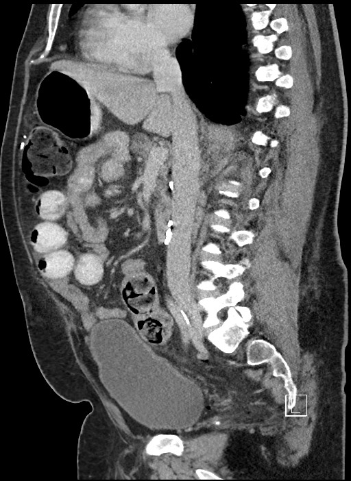 Closed loop obstruction - internal hernia into nephrectomy bed (Radiopaedia 59867-67320 C 53).jpg